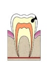 Images dental cavity 3