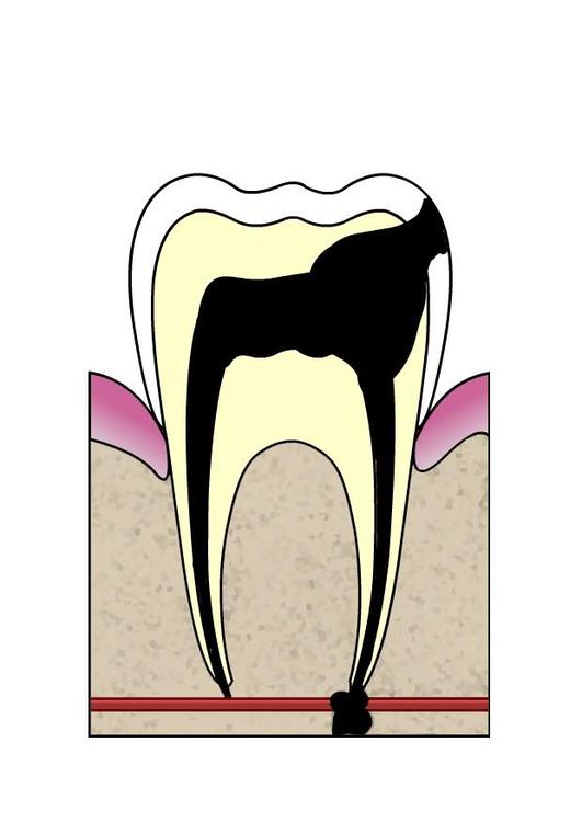 dental cavity 5