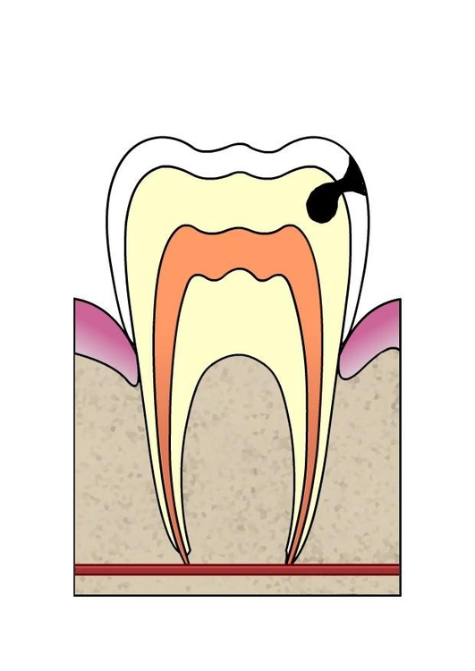 Image dental cavity 3