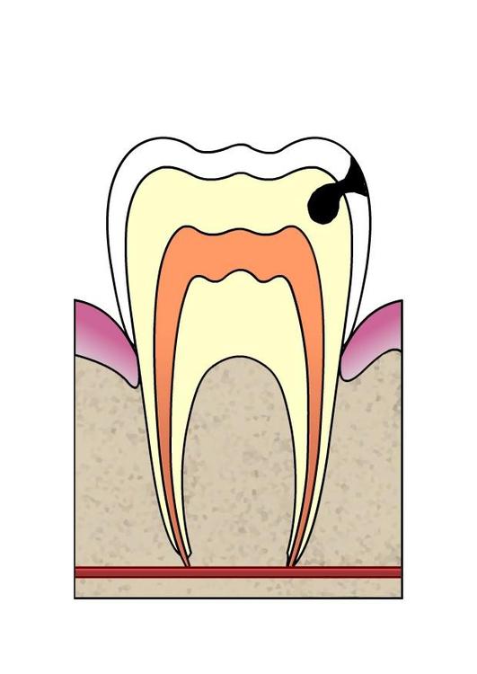 dental cavity 3