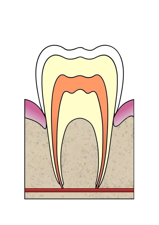 Image dental cavity 1