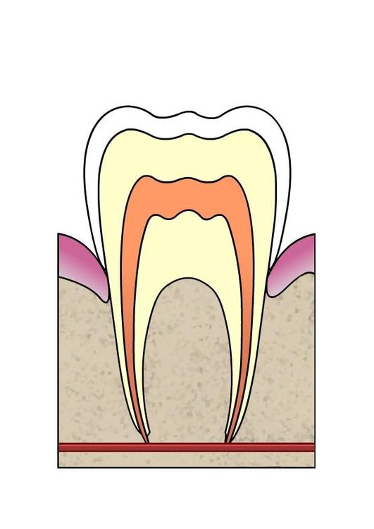 dental cavity 1