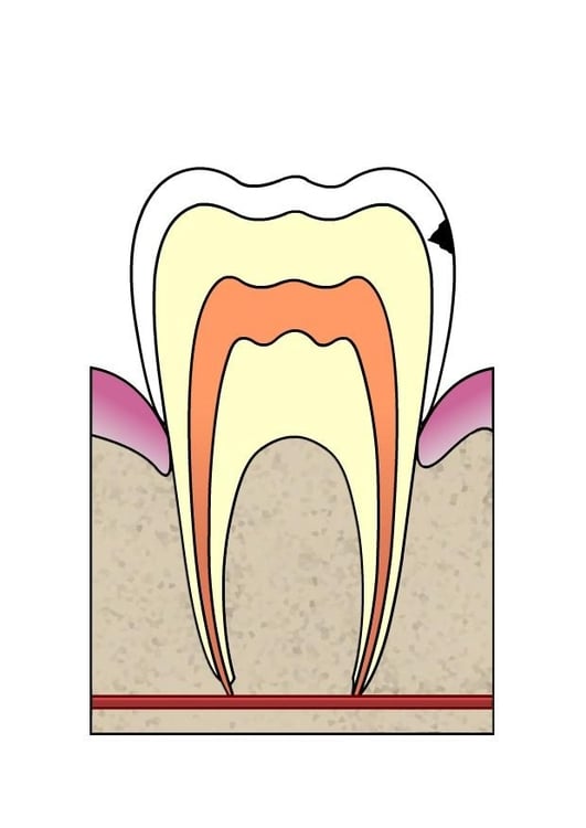 Image dental cavity 2
