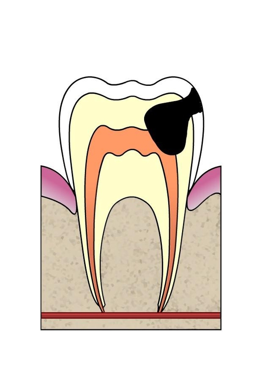 Image dental cavity 4