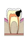 Image dental cavity 4