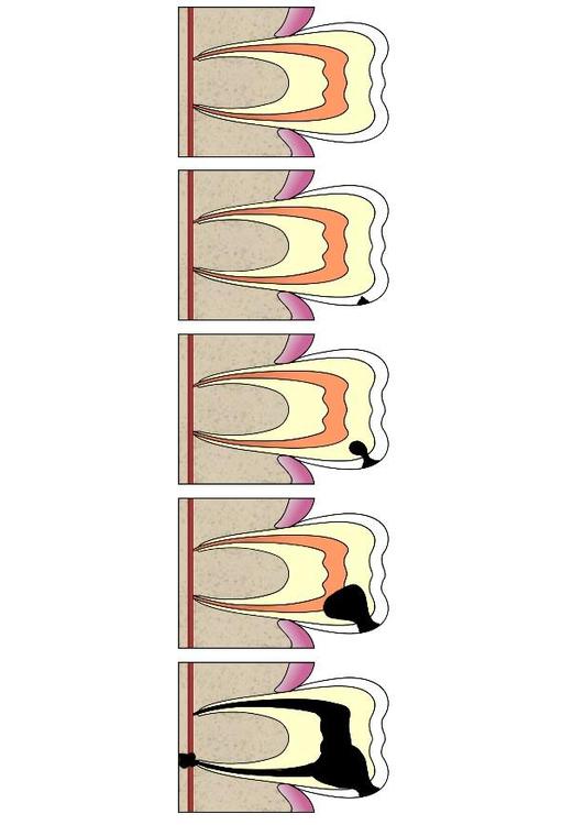 dental cavity