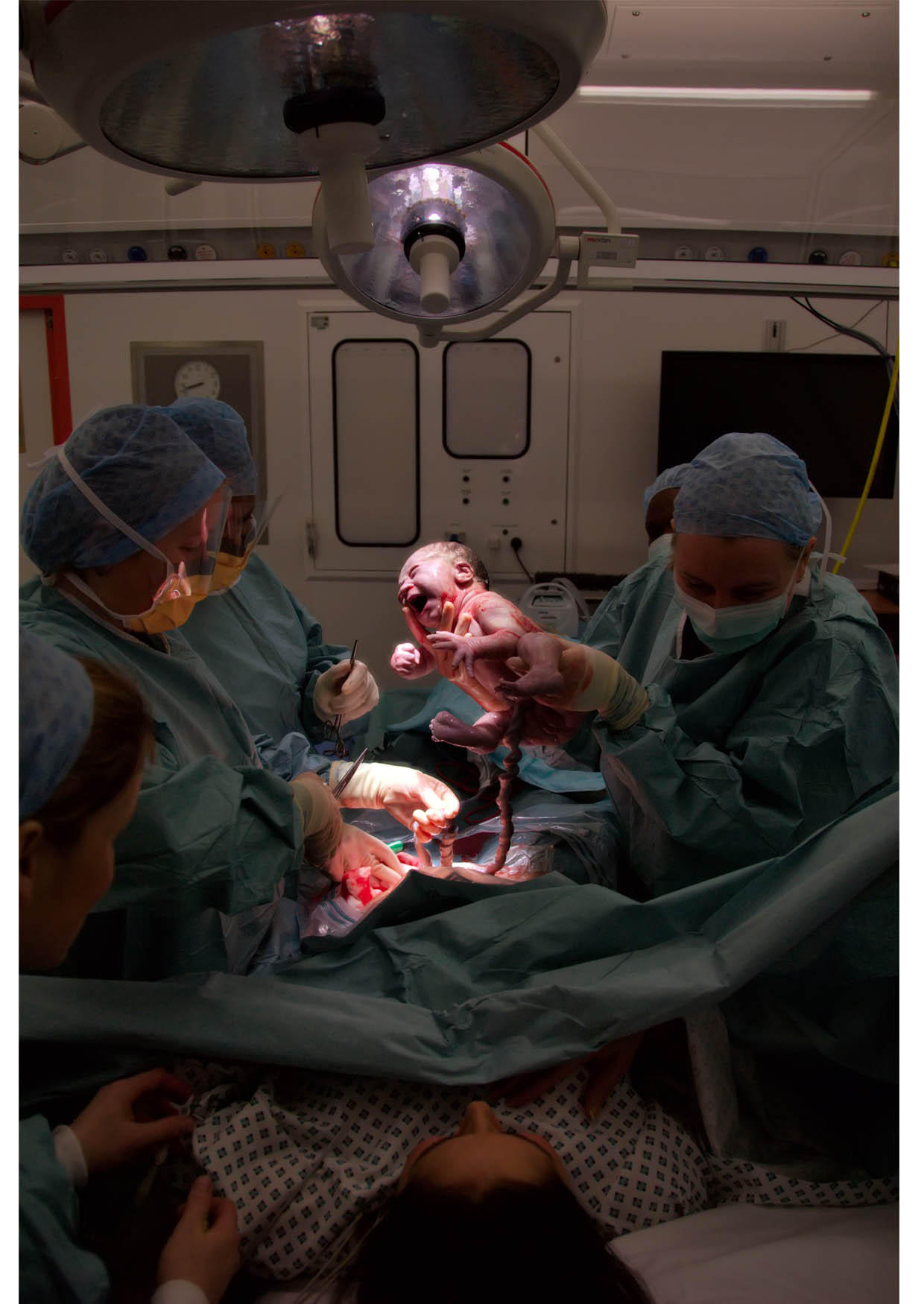 birth by caesarean Photo birth by caesarean