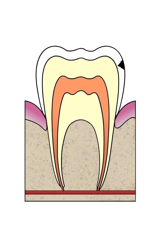 dental cavity 2 Image dental cavity 2