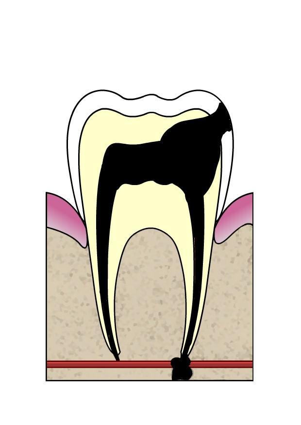 dental cavity 5 Image dental cavity 5